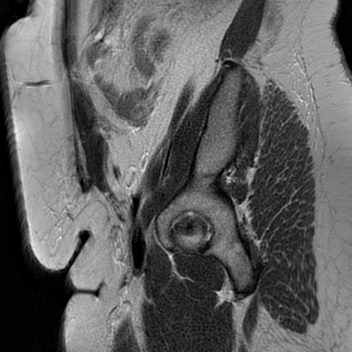 File:Adenomyosis within a didelphys uterus (Radiopaedia 70175-80215 Sagittal T2 3).jpg