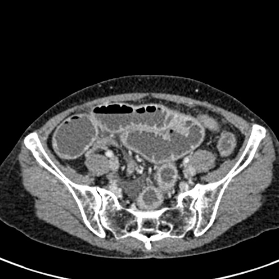 Adhesional small bowel obstruction (Radiopaedia 48397-53305 Axial C+ portal venous phase 69).jpg