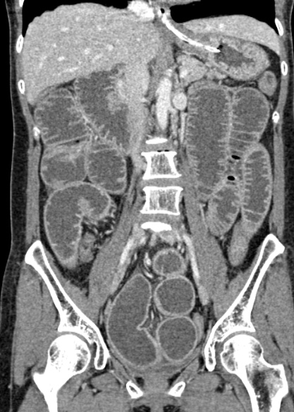 Adhesional small bowel obstruction (Radiopaedia 48397-53305 Coronal C+ portal venous phase 181).jpg