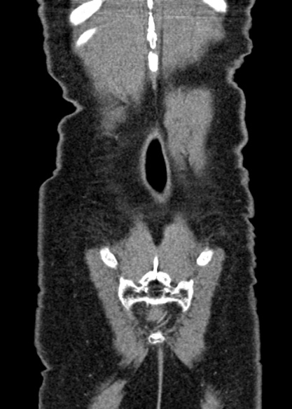Adhesional small bowel obstruction (Radiopaedia 48397-53305 Coronal C+ portal venous phase 328).jpg