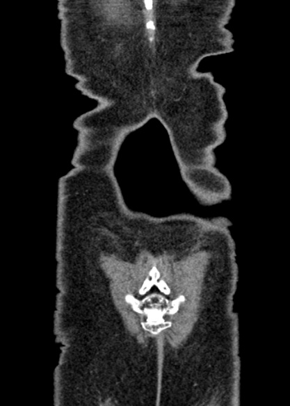 Adhesional small bowel obstruction (Radiopaedia 48397-53305 Coronal C+ portal venous phase 339).jpg