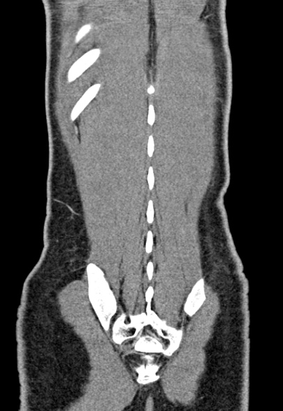 Adhesional small bowel obstruction (Radiopaedia 52107-57980 Coronal C+ portal venous phase 74).jpg