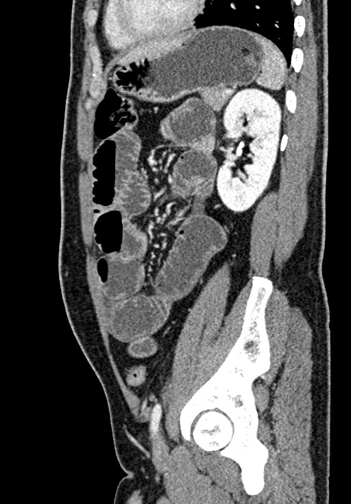 Adhesional small bowel obstruction (Radiopaedia 58900-66131 Sagittal C+ portal venous phase 178).jpg