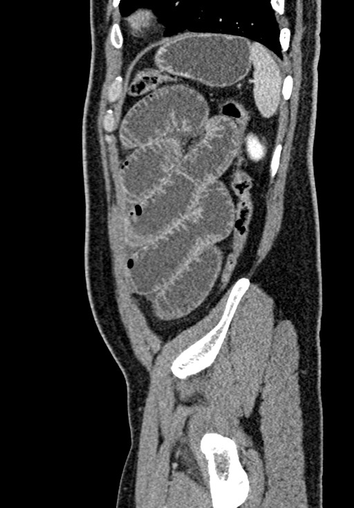 Adhesional small bowel obstruction (Radiopaedia 58900-66131 Sagittal C+ portal venous phase 209).jpg