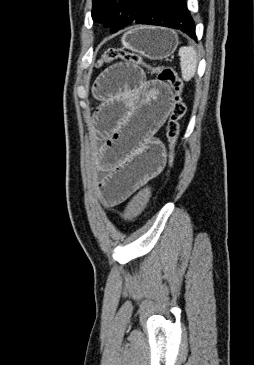 Adhesional small bowel obstruction (Radiopaedia 58900-66131 Sagittal C+ portal venous phase 215).jpg
