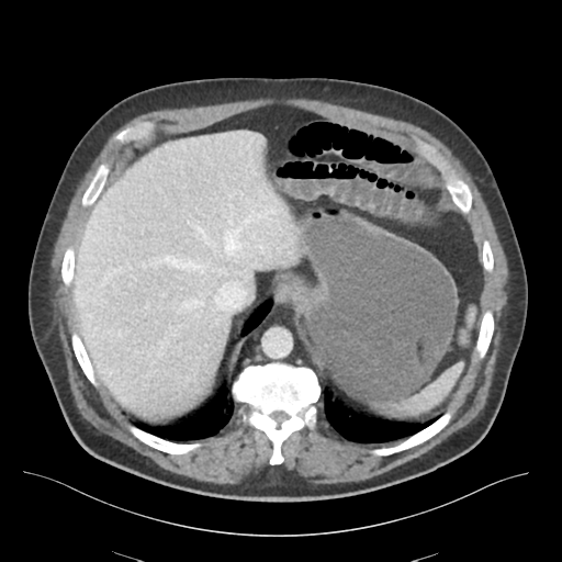 File:Adhesions within abdominal wall hernia (Radiopaedia 58283-65394 Axial C+ portal venous phase 16).png