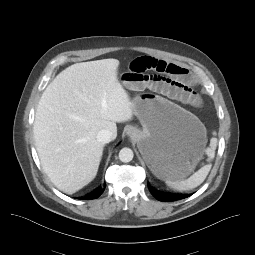 Adhesions within abdominal wall hernia (Radiopaedia 58283-65394 Axial C+ portal venous phase 17).png