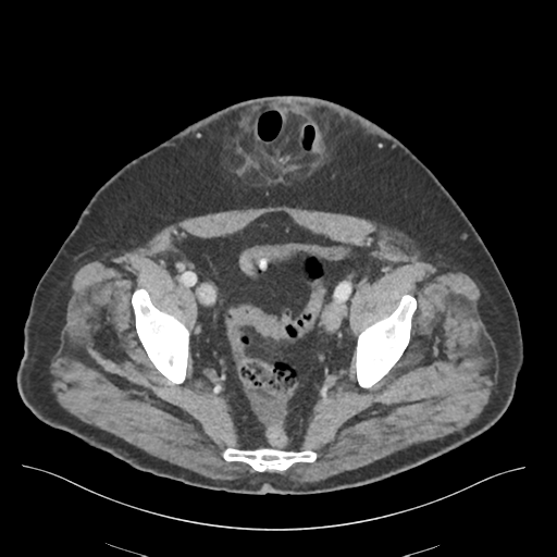 File:Adhesions within abdominal wall hernia (Radiopaedia 58283-65394 Axial C+ portal venous phase 72).png