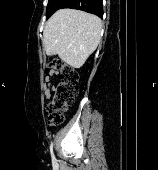 File:Adrenal cortical carcinoma (Radiopaedia 84882-100379 Sagittal C+ portal venous phase 18).jpg