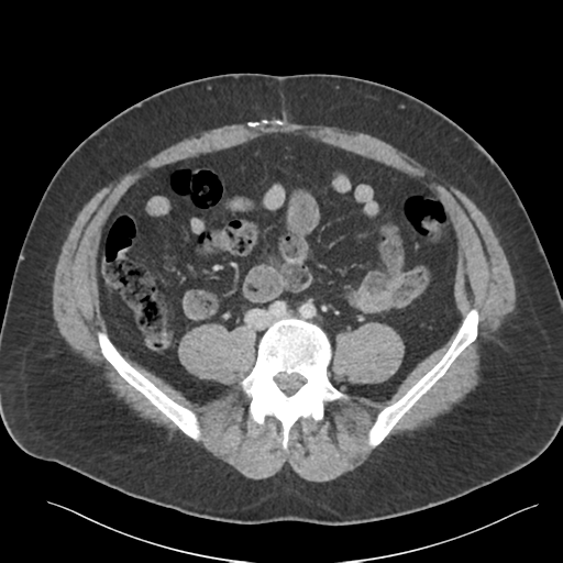 File:Adrenal cyst (Radiopaedia 45625-49777 Axial C+ portal venous phase 66).png