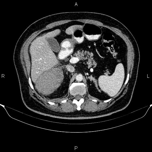 Adrenal hemorrhage (Radiopaedia 62622-70916 Axial C+ portal venous phase 60).jpg