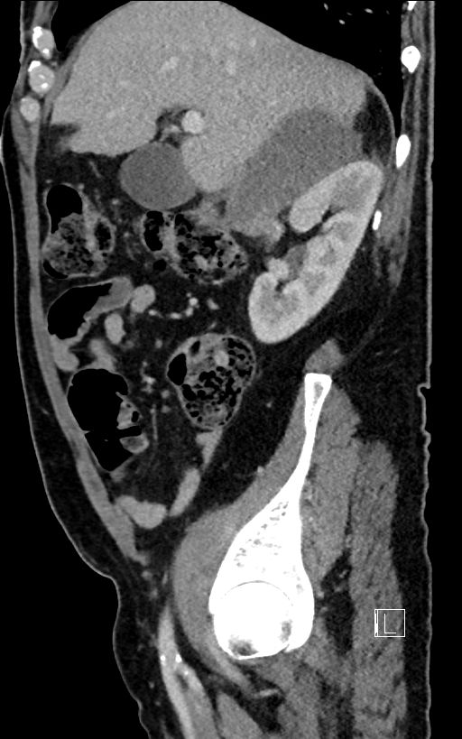 Adrenal lymphoma (Radiopaedia 73730-84529 Sagittal C+ portal venous phase 34).jpg