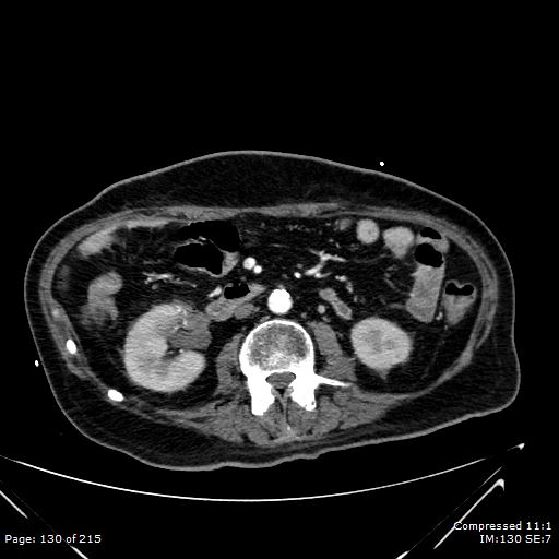 Adrenal metastasis (Radiopaedia 78425-91079 Axial C+ arterial phase 60).jpg