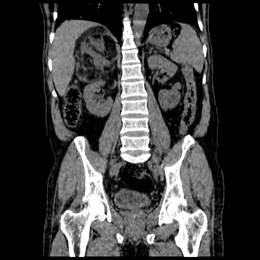 File:Adrenal myelolipoma (Radiopaedia 41843-44834 Coronal non-contrast 11).jpg