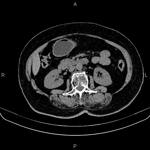 Adrenal myelolipoma (Radiopaedia 82742-96986 Axial non-contrast 73).jpg