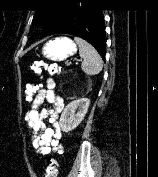Adrenal myelolipoma (Radiopaedia 84319-99617 Sagittal renal cortical phase 75).jpg