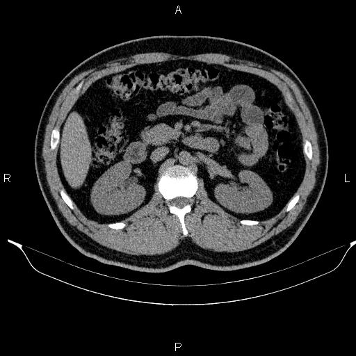 Adrenal myelolipoma (Radiopaedia 84321-99619 Axial non-contrast 46).jpg