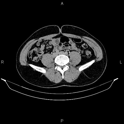 Adrenal myelolipoma (Radiopaedia 87794-104246 Axial renal excretory phase 65).jpg