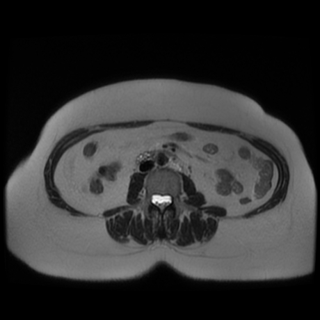 File:Adrenal myelolipoma - MRI (Radiopaedia 83249-97646 Axial T2 28).jpg