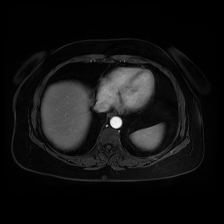 Adrenal myelolipoma - MRI (Radiopaedia 83249-97646 T1 fat sat arterial phase 2).jpg