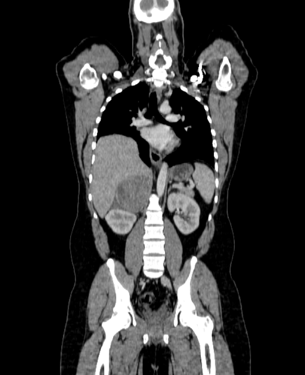 Adrenocortical carcinoma (Radiopaedia 80134-93438 Coronal C+ portal venous phase 101).jpg