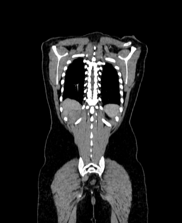 Adrenocortical carcinoma (Radiopaedia 80134-93438 Coronal C+ portal venous phase 141).jpg