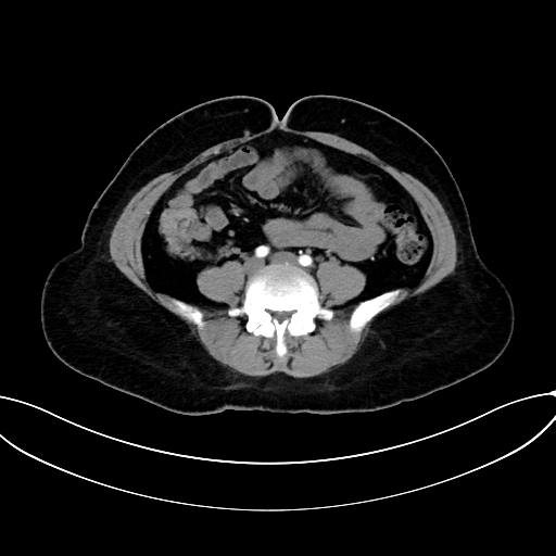 Adrenocortical carcinoma (Radiopaedia 87281-103569 Axial C+ arterial phase 57).jpg