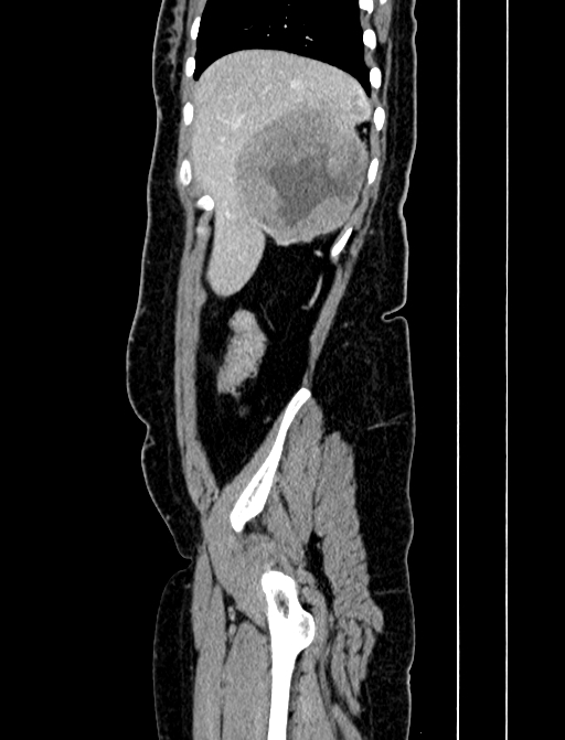 Adrenocortical carcinoma (Radiopaedia 87281-103569 Sagittal C+ portal venous phase 36).jpg