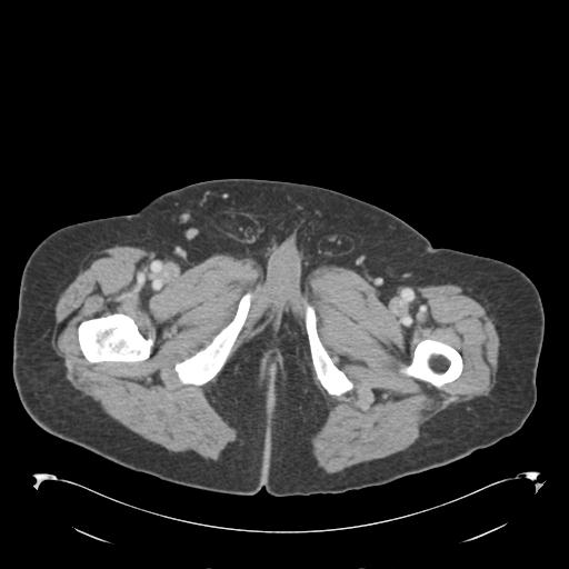Adult ileal intussusception with secondary obstruction (Radiopaedia 30395-31051 Axial C+ portal venous phase 86).jpg