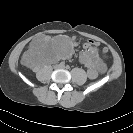 File:Adult polycystic kidney disease (Radiopaedia 47866-52626 Axial non-contrast 50).png