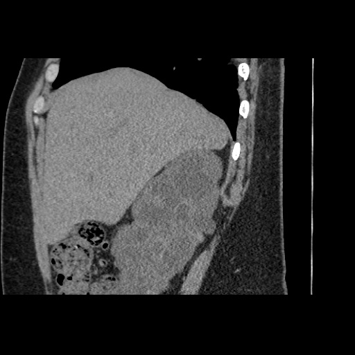 Adult polycystic kidney disease (Radiopaedia 59075-66368 Sagittal non-contrast 10).jpg