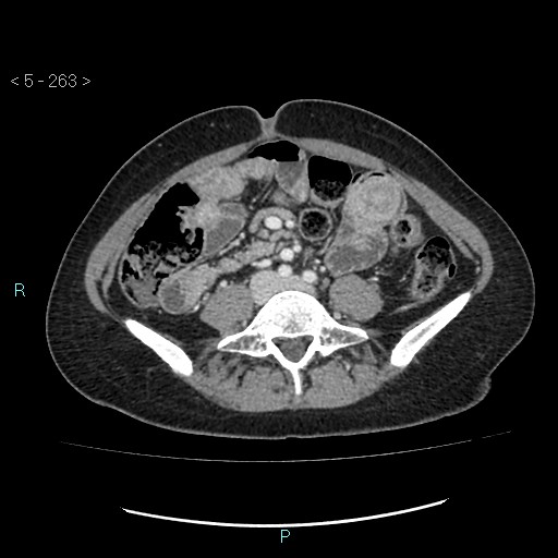 File:Adult transient intestinal intussusception (Radiopaedia 34853-36310 Axial C+ portal venous phase 57).jpg