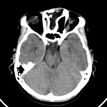 Agenesis of the left hepatic lobe (Radiopaedia 77284-89359 Axial C+ CTPA 21).jpg