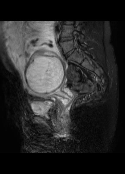 File:Aggressive angiomyxoma of the pelvis and perineum (Radiopaedia 59162-66479 Sagittal T2 fat sat 15).jpg