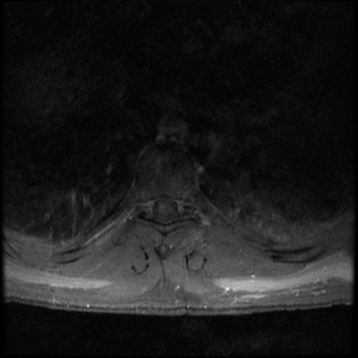 File:Aggressive vertebral hemangioma (Radiopaedia 39937-42404 Axial T1 C+ fat sat 15).png