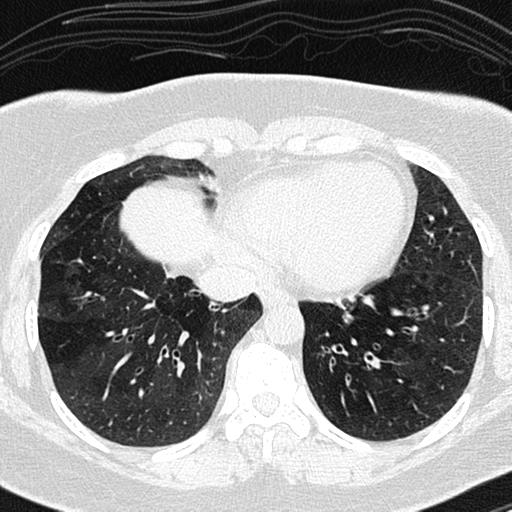 File:Air trapping in small airway disease (Radiopaedia 61685-69694 Axial lung window 131).jpg
