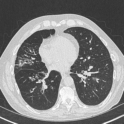 Allergic bronchopulmonary aspergillosis (Radiopaedia 44760-48571 Axial lung window 41).png