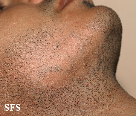Alopecia Areata (Dermatology Atlas 33).jpg