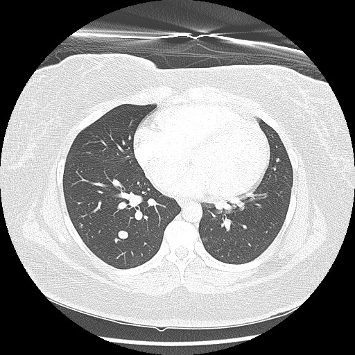 Alveolar soft part sarcoma - right leg (Radiopaedia 59432-67091 Axial lung window 70).jpg