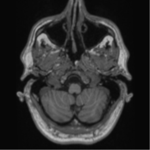 File:Alzheimer's disease- with Gerstmann syndrome and dressing apraxia (Radiopaedia 54882-61150 Axial T1 10).png