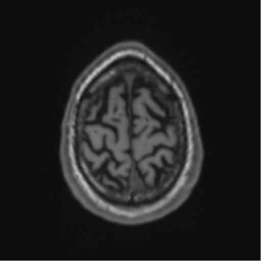 Alzheimer's disease- with Gerstmann syndrome and dressing apraxia (Radiopaedia 54882-61150 Axial T1 67).png