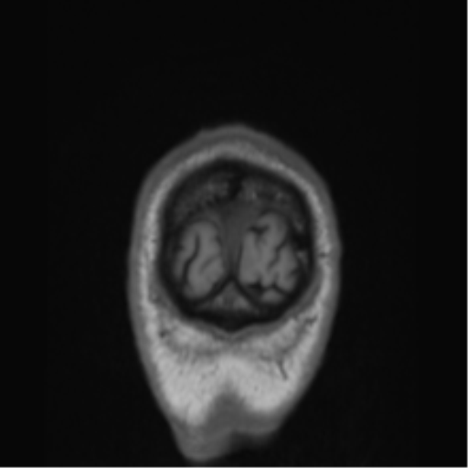 File:Alzheimer's disease- with Gerstmann syndrome and dressing apraxia (Radiopaedia 54882-61150 Coronal T1 2).png