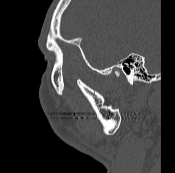 Ameloblastoma (Radiopaedia 77750-89997 Sagittal bone window 103).jpg