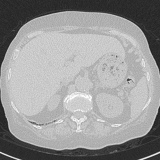 File:Amiodarone-induced pulmonary fibrosis (Radiopaedia 82355-96460 Axial lung window 67).jpg