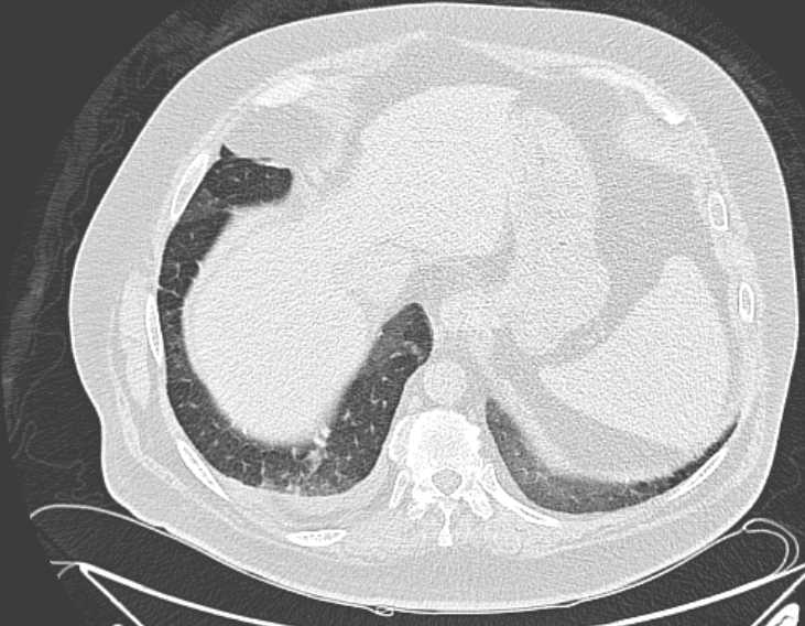 File:Amiodarone lung (Radiopaedia 62514-70769 Axial lung window 74).jpg