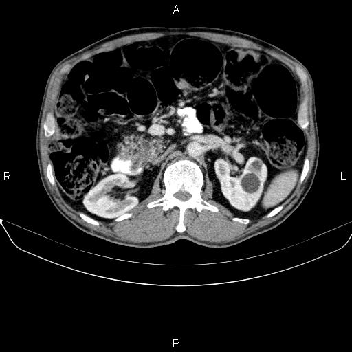 Ampullary adenocarcinoma (Radiopaedia 86093-102032 A 24).jpg