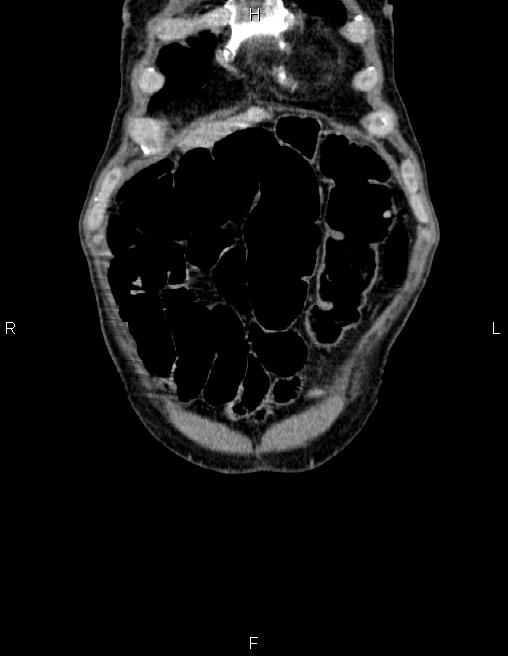 Ampullary adenocarcinoma (Radiopaedia 86093-102032 C 3).jpg