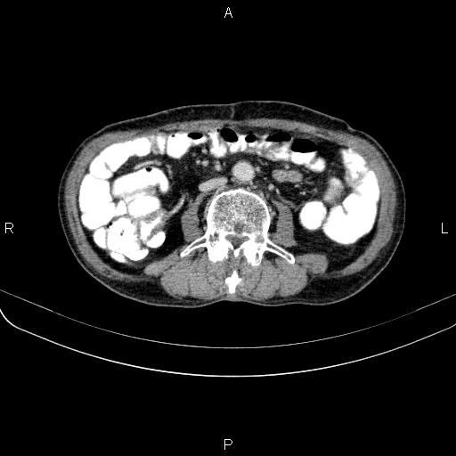 Ampullary adenocarcinoma (Radiopaedia 86093-102033 B 75).jpg