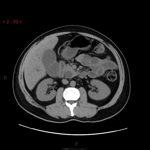 File:Ampullary carcinoma (Radiopaedia 56396-63056 Axial non-contrast 22).jpg
