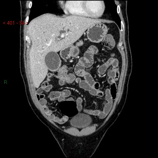 Ampullary carcinoma (Radiopaedia 56396-63056 E 33).jpg